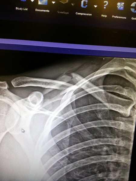 broken collarbone xray